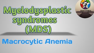 Myelodysplastic syndromes MDS in Hindi ll Macrocytic Anemia ll [upl. by Wertheimer]