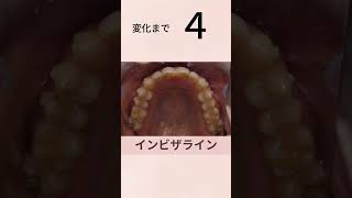 前歯のねじれ（翼状捻転）の改善 歯並び 歯列矯正 裏側矯正 矯正専門 歯並び 八重歯 でこぼこ 三軒茶屋 矯正 Crowding orthodontics [upl. by Allak265]