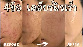 4 ข้อเคลียร์ผิวเร็ว รูทีนสิวหาย Clear Skin Routine [upl. by Taimi]