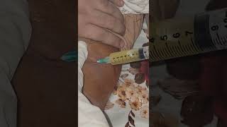 Removing Fluid From Knee Joint arthritis kneepain [upl. by Tempa628]