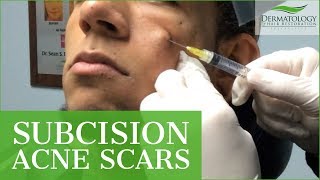 Subcision for ACNE SCARS  Procedure  Dr Ben Behnam  Los Angeles [upl. by Tamah159]