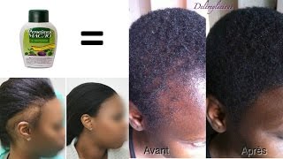 Comment FAIRE POUSSER les CHEVEUX des TEMPES [upl. by Gwenn]