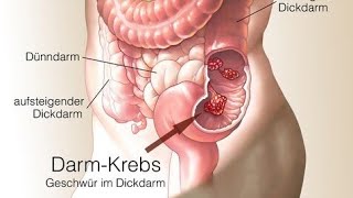 Darmkrebs Risikofaktoren Ursachen Diagnose und Therapie [upl. by Kuehn904]