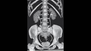 CT Urography  Post Processed urology ct radiology xray shorts video viralvideo trending [upl. by Ativoj521]