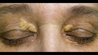 Xanthelasma [upl. by Nawrocki807]