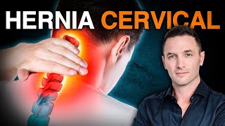 ¿Dolor de Cuello o Cabeza Posible Hernia Cervical  Soluciones Efectivas ✅ [upl. by Fink112]