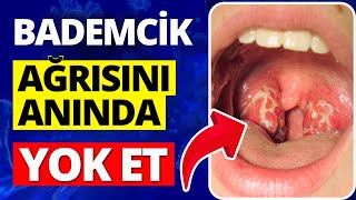 Bademcik Şişmesine Ne iyi Gelir Bademcik İltihabı Nasıl Geçer [upl. by Aekerly]