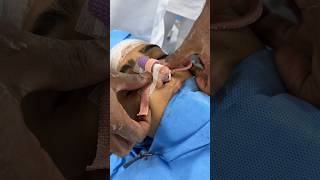 Nose Packing and Nasal splint after rhinoplasty [upl. by Tj106]