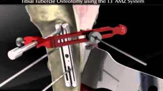 Tibial Tubercle Osteotomy using the T3 AMZ System [upl. by Acirat]