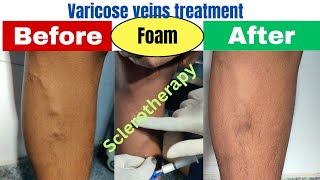 Foam Sclerotherapy  follow up result after 2 months Varicose veins treatment by DrPankaj Kumar [upl. by Sachi]