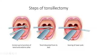 Tonsillectomy  ENT Lecture Series [upl. by Aciretahs616]