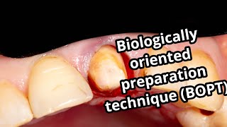 Biologically oriented preparation technique BOPT a new approach for prosthetic restoration [upl. by Akihsay]