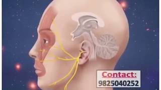 Trigeminal neuralgia treatment radio frequency ablation in ahmedabad gujrat [upl. by Andris]