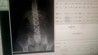 Digital X Ray lumber spine ap lateral view with thoracic spine edit Fcr software CR Fuji flim [upl. by Nichola]