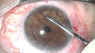 DMEK surgery sutureless corneal transplant [upl. by Pradeep]