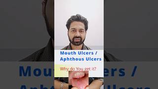 Mouth ulcersaphthous ulcers common causes of getting it ulcers mouthulcer drskanda [upl. by Glen]