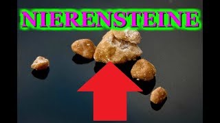 NIERENSTEINE DURCH ZU VIEL PROTEIN [upl. by Eiramlatsyrc]