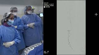 Transpedal Approach for FemoralPopliteal Chronic Total Occlusion Extended Version [upl. by Anyat]