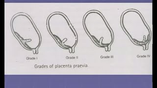 Antepartum Haemorrhage Lecture in Hindi  APH in Pregnancy  causes  Obstetrics and Gynecology OBS [upl. by Zarah428]