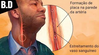 ATEROSCLEROSE – Sintomas Prevenção e Tratamento  Biologia com Patrick Gomes [upl. by Tarazi158]