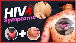 Early Signs of HIV AIDS in Men and Women  HIV Positive Signs [upl. by Anelac]