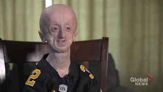 Second oldest in the world with rare genetic disorder Hamilton man “keep’s fighting” [upl. by Suollecram]