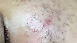 This is what your Blackhead removal should be poppingblackheads 5505 [upl. by Thera]