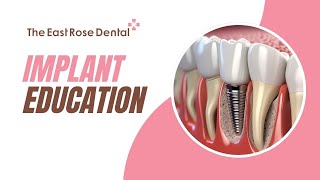 Implant Education Video [upl. by Ariay63]