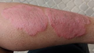 Dead Sea Day 5 results Psoriasis [upl. by Nivle]