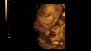 2D3D Twin Ultrasound at 24 weeks [upl. by Eivla]