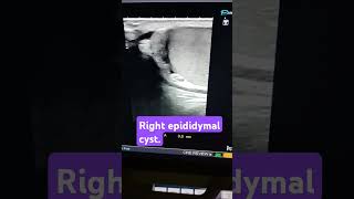 testicular ultrasoundright epididymal cyst [upl. by Benildas]