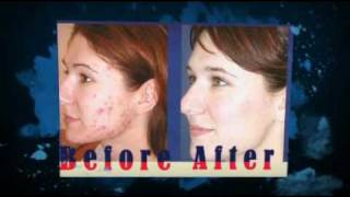 Tetracycline Acne Treatment [upl. by Yssep]