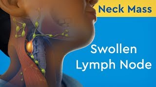 Neck Mass Swollen Lymph Node [upl. by Vershen216]