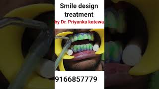 Teeth whitening process [upl. by Nairot]