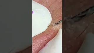 Pickel Ausdrücken Blackheads Akne amp Mitesser entfernen 🔴 35 [upl. by Noteloc]