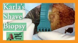 Karlas Skin Lesion Biopsy  Auburn Medical Group [upl. by Cyprio]