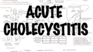 Acute Cholecystitis  Overview signs and symptoms pathophysiology treatment [upl. by Nniuqal]