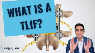 How I perform a TLIF and what to expect after [upl. by Odraccir]