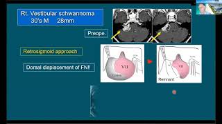 Combined Transpetrosal Approach for CP Angle Tumors [upl. by Yenroc144]