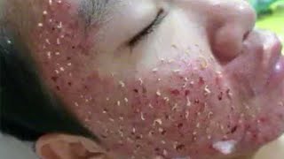 Big Cystic Acne Blackheads Extraction Blackheads amp Milia Whiteheads Removal Pimple Popping  6772 [upl. by Ynohtnakram]