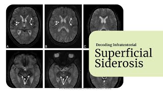 Decoding Superficial Siderosis [upl. by Anjela]