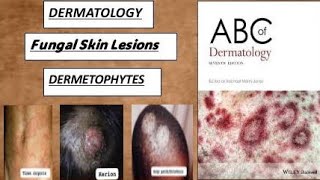 DERMATOLOGY Fungal skin lesions  DERMATOPHYTES derma lesion fungal dermetophytes tinea worms [upl. by Blanka972]