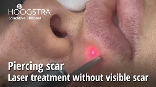 Piercing scar  Laser treatment without visible scar  24094 [upl. by Cirdes842]