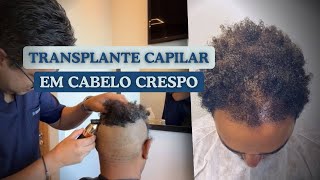 Descubra a Vantagem do Cabelo Crespo no Transplante Capilar [upl. by Esinnej698]