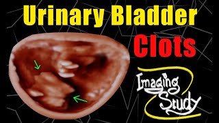 Urinary Bladder Clots  Ultrasound  Case 122 [upl. by Onitselec182]