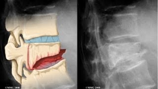 Vertebral Compression Fracture Explained by a Top Pain Physician in Las Vegas Nevada [upl. by Bancroft642]