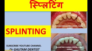 SPLINTING to STOP MOBILITY of teeth स्प्लिंटिंग दांत को स्थिर करने के लिए किया जाता है [upl. by Aissac383]