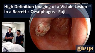 High Definition Imaging of a Visible Lesion in a Barretts Oesophagus [upl. by Eicart]