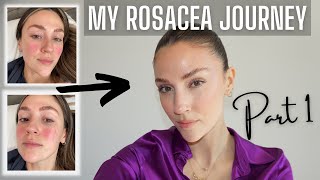 MY ROSACEA JOURNEY PART 1  TIPS AND TRICKS  MANAGING INFLAMMATION [upl. by Aisiat]