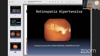 Clase de Retinopatia diabetica e hipertensiva 2022 [upl. by Ativ]